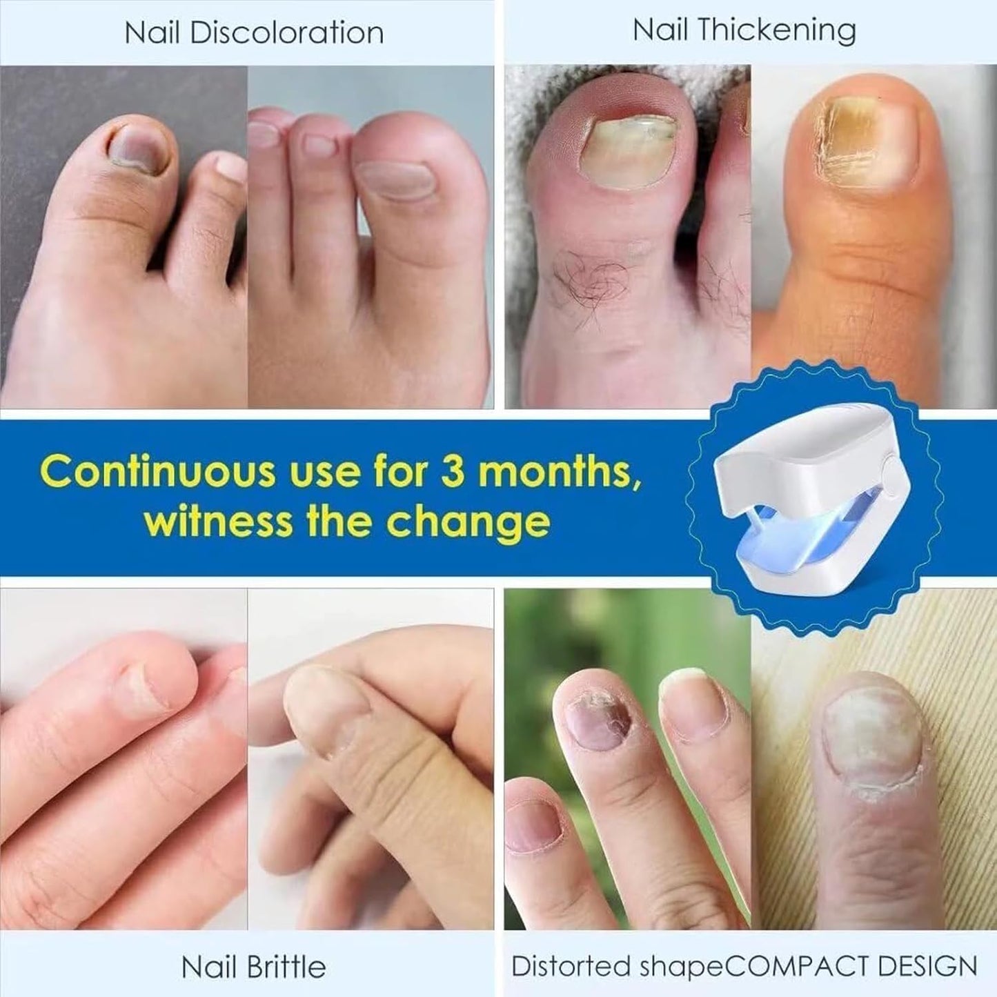 NailHeal Pro™ – Nail Fungus Treatment Device