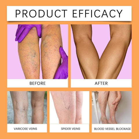 VeinVeda™ Varicose Vein Relief Spray ( BUY 1 GET 2 FREE )