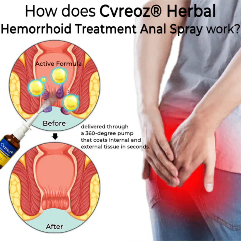 Cvreoz® Herbal Hemorrhoid Treatment Anal Spray (Buy 1 Get 1 Free)