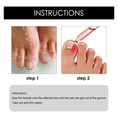 SouthMoon Ingrown Toenail Drops Nail Fungal Repair ( BUY 1 GET 2 FREE )