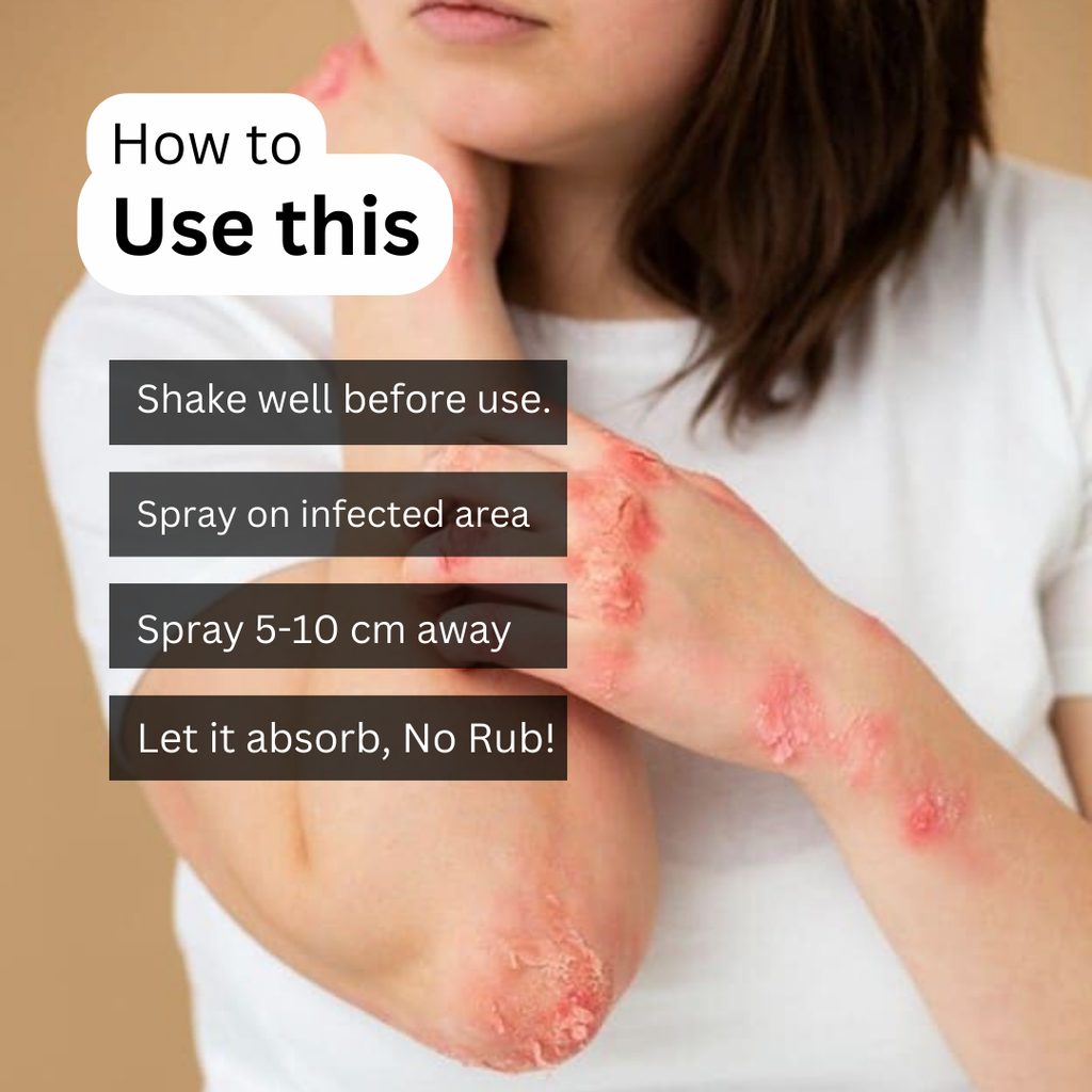 ItchXpert Anti Fungal Spray (30ml)