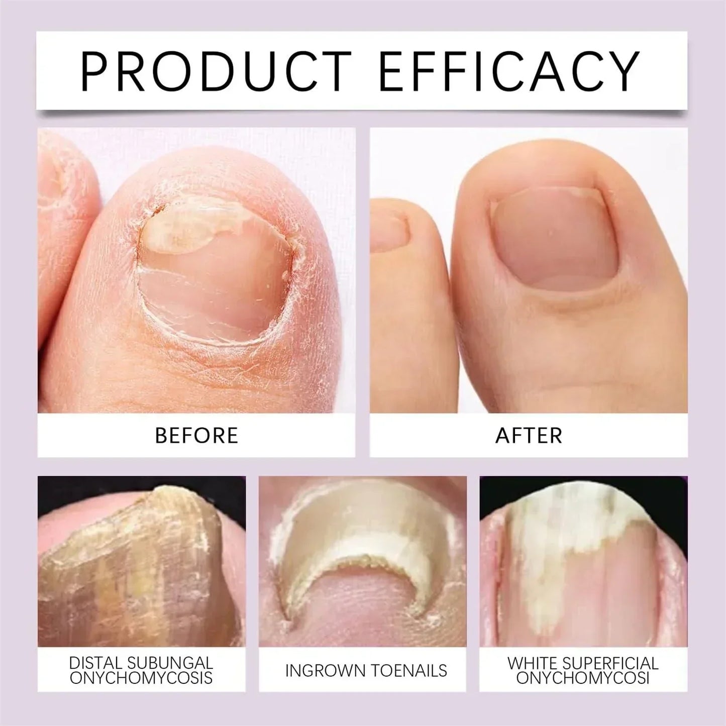 NailRevive™ Nail Growth & Repair Serum ( BUY 1 GET 2 FREE )