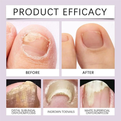 NailRevive™ Nail Growth & Repair Serum ( BUY 1 GET 2 FREE )