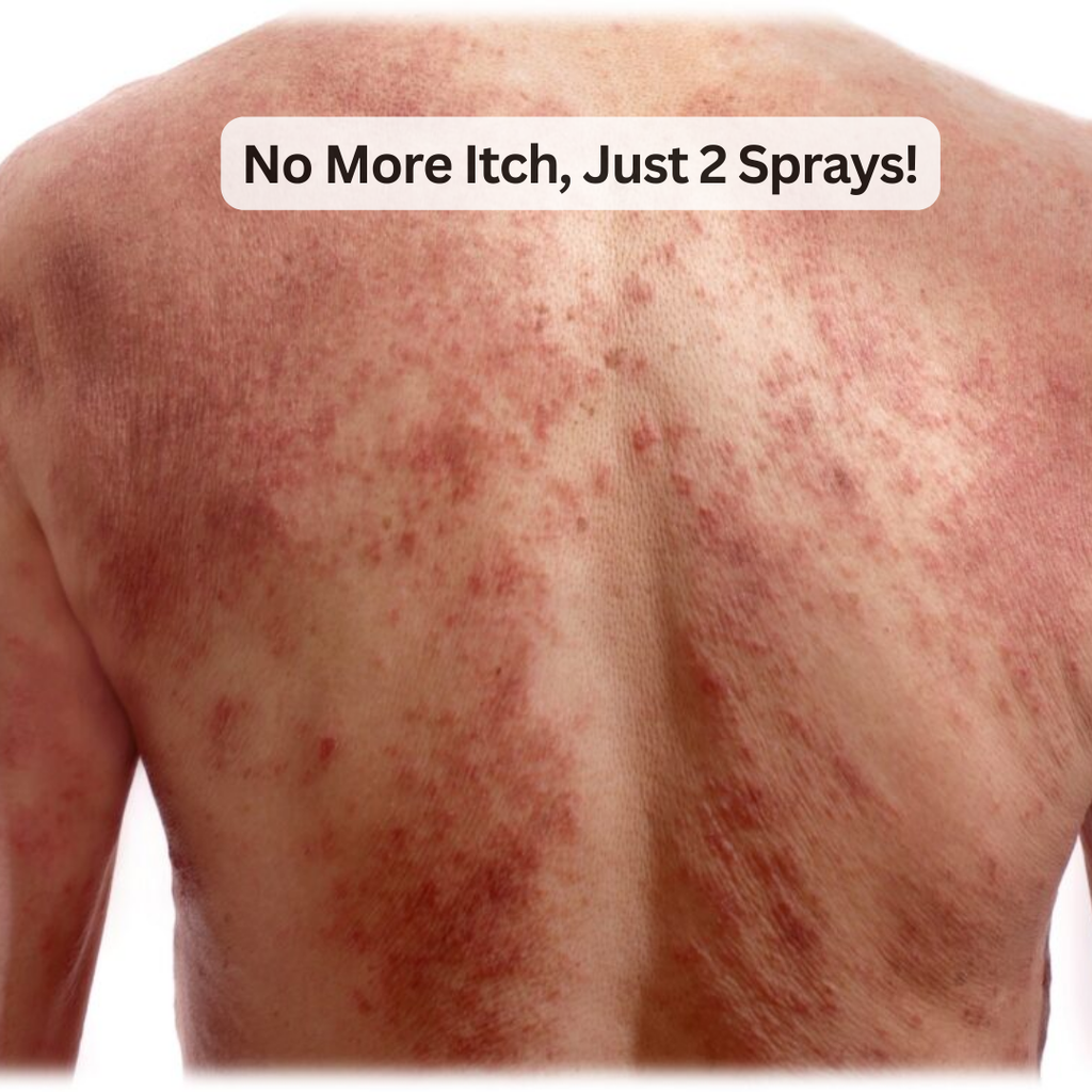 ItchXpert Anti Fungal Spray (30ml)