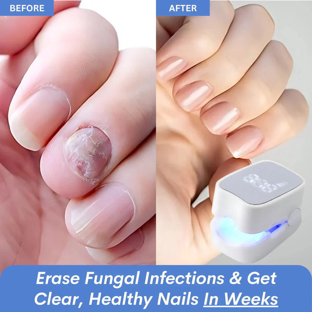 NailHeal Pro™ – Nail Fungus Treatment Device