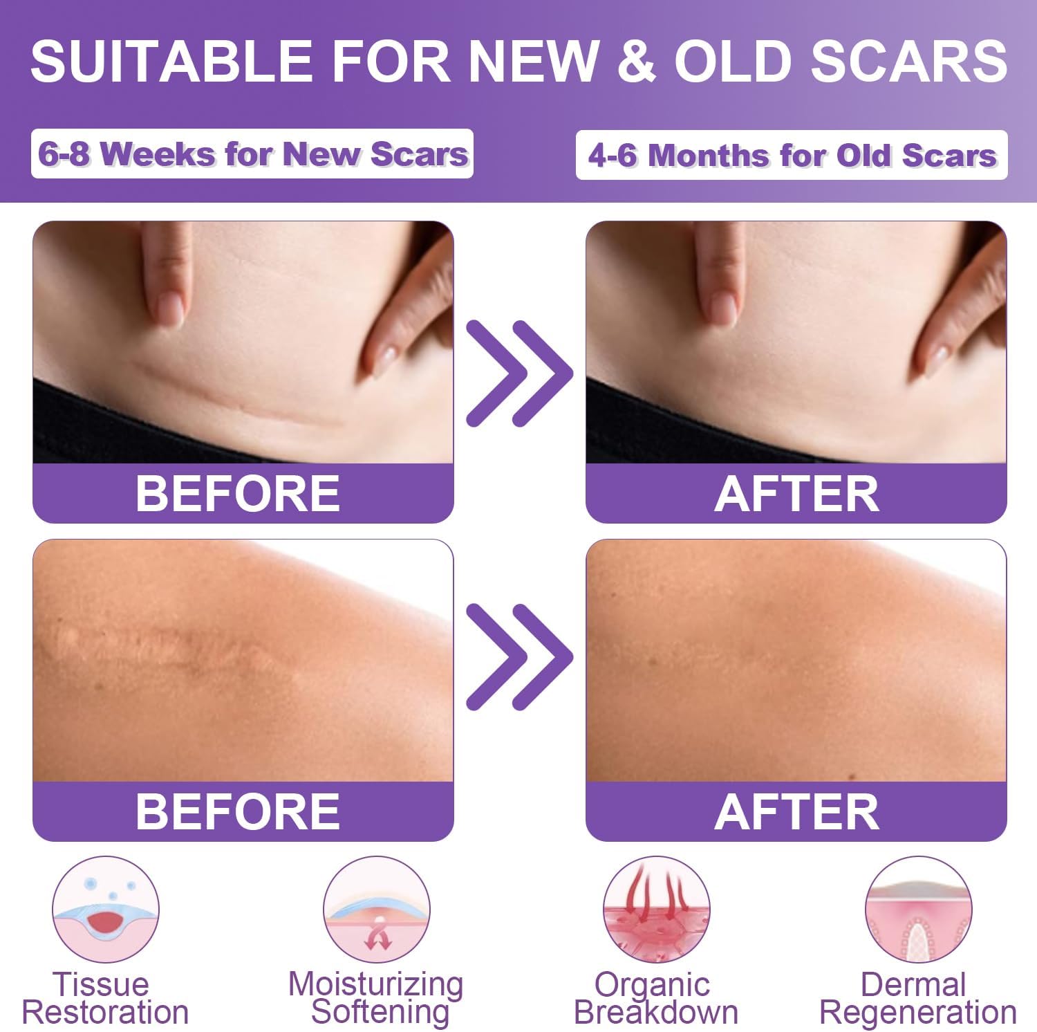 Silicone Scar Remover Tape for Acne & Wrinkles