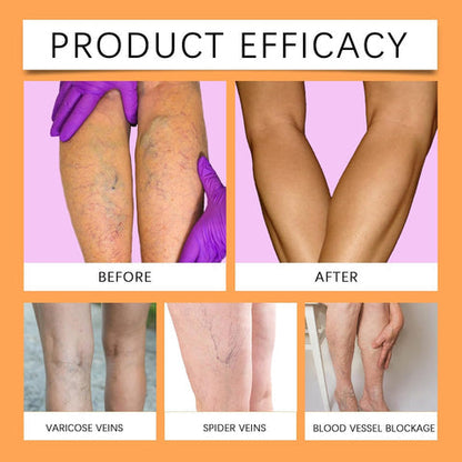 VeinVeda™ Varicose Vein Relief Spray ( BUY 1 GET 2 FREE )