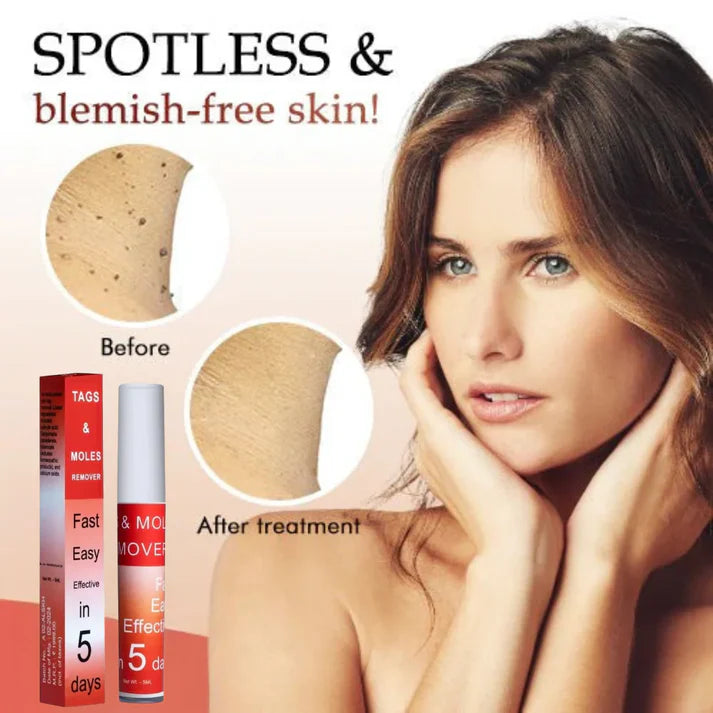 LOVILDS™ Tags & Moles Remover (Buy 1 Get 1 Free🔥🔥)