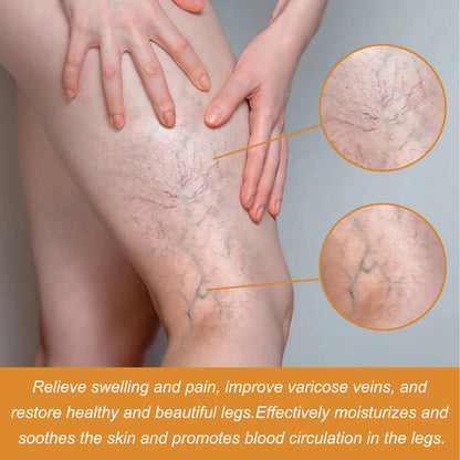 VeinVeda™ Varicose Vein Relief Spray ( BUY 1 GET 2 FREE )
